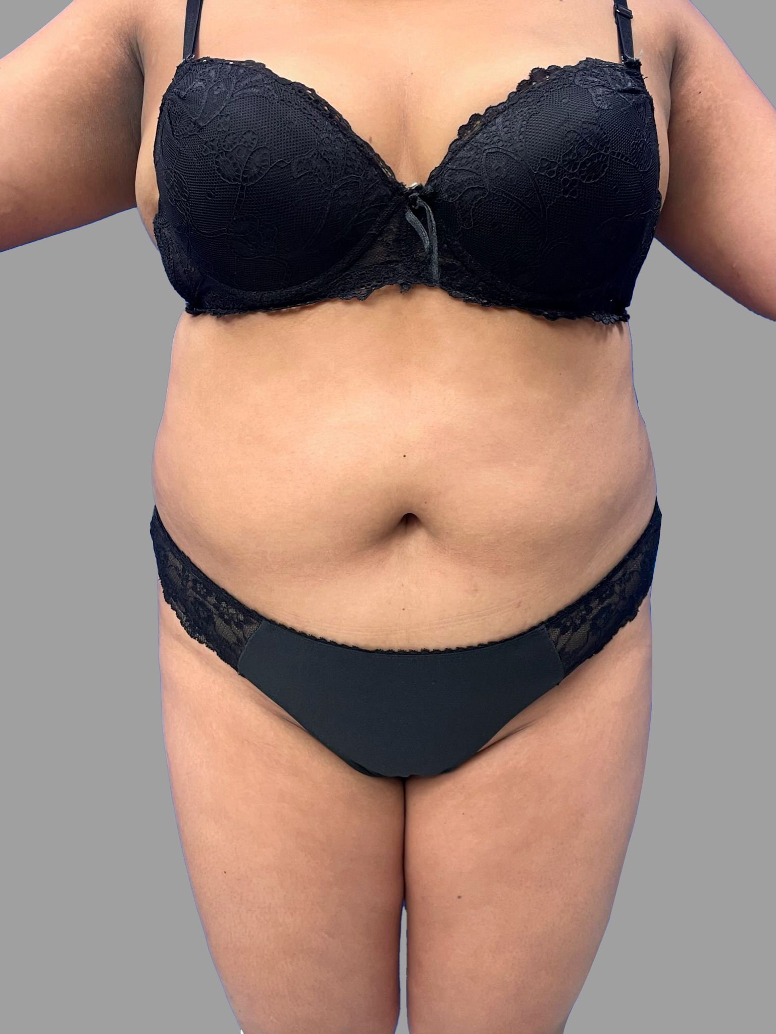 Liposuction 360 with BBL