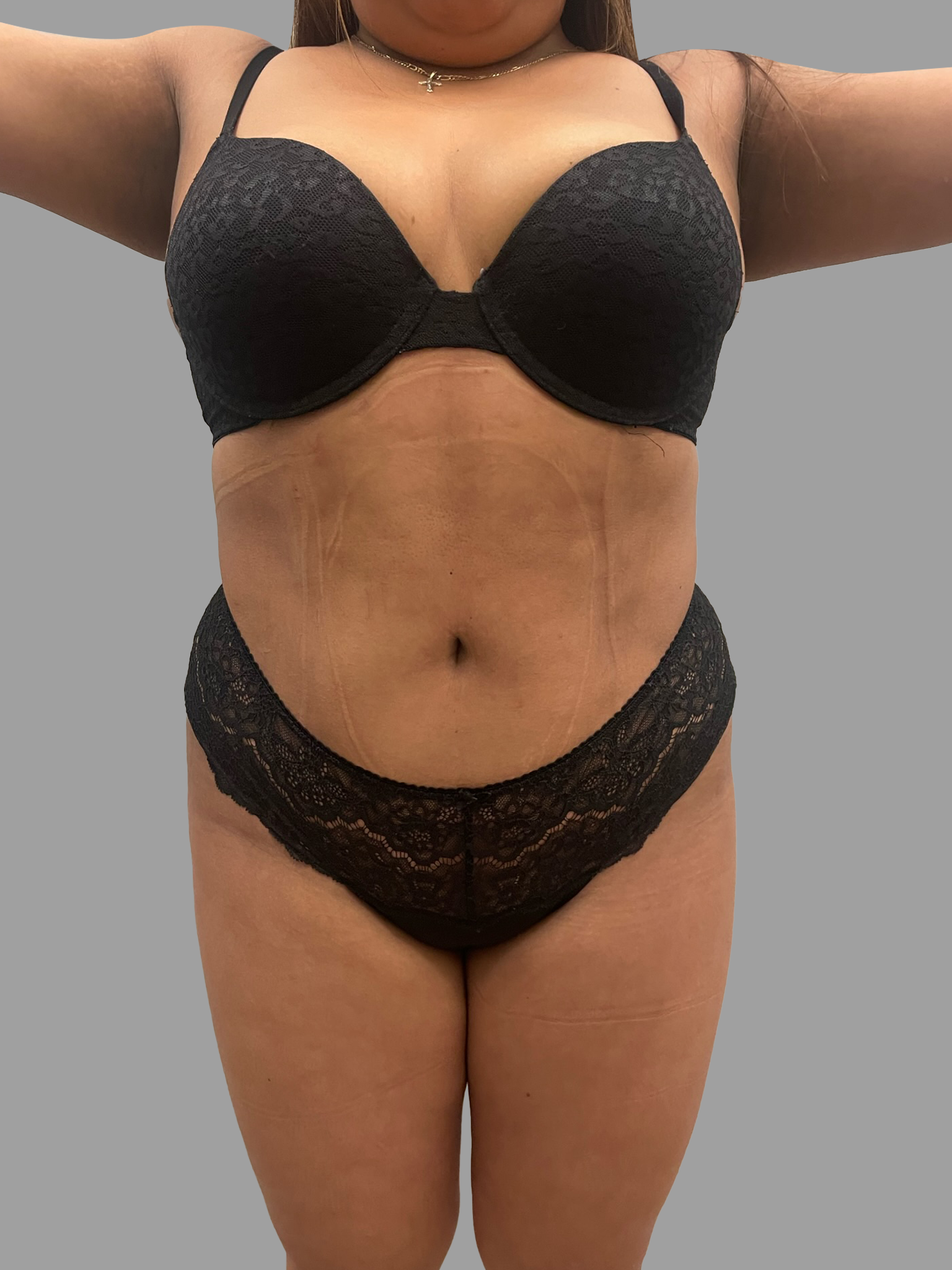 Liposuction 360 with BBL