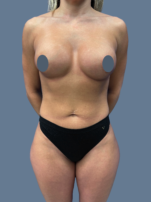 Case--1288-Breast-Augmentation | Before Breast