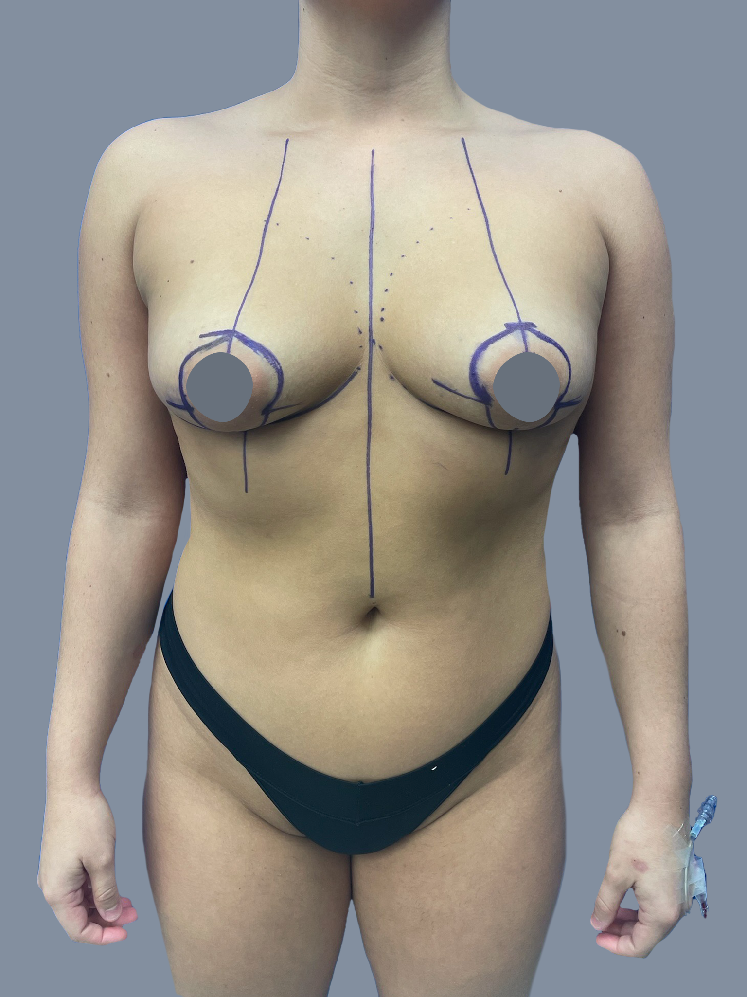 Breast Augmentation with lift 1