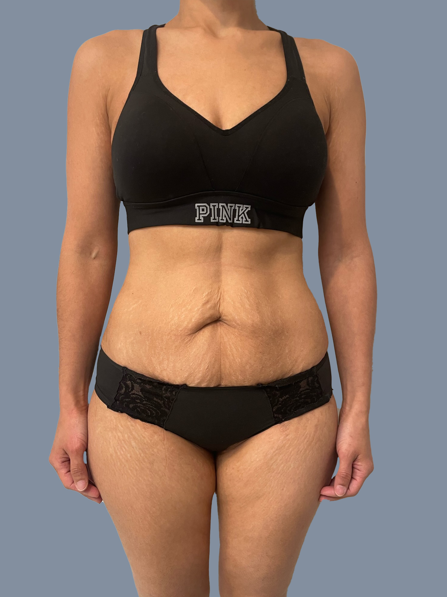 Liposuction 360 & Tummy Tuck