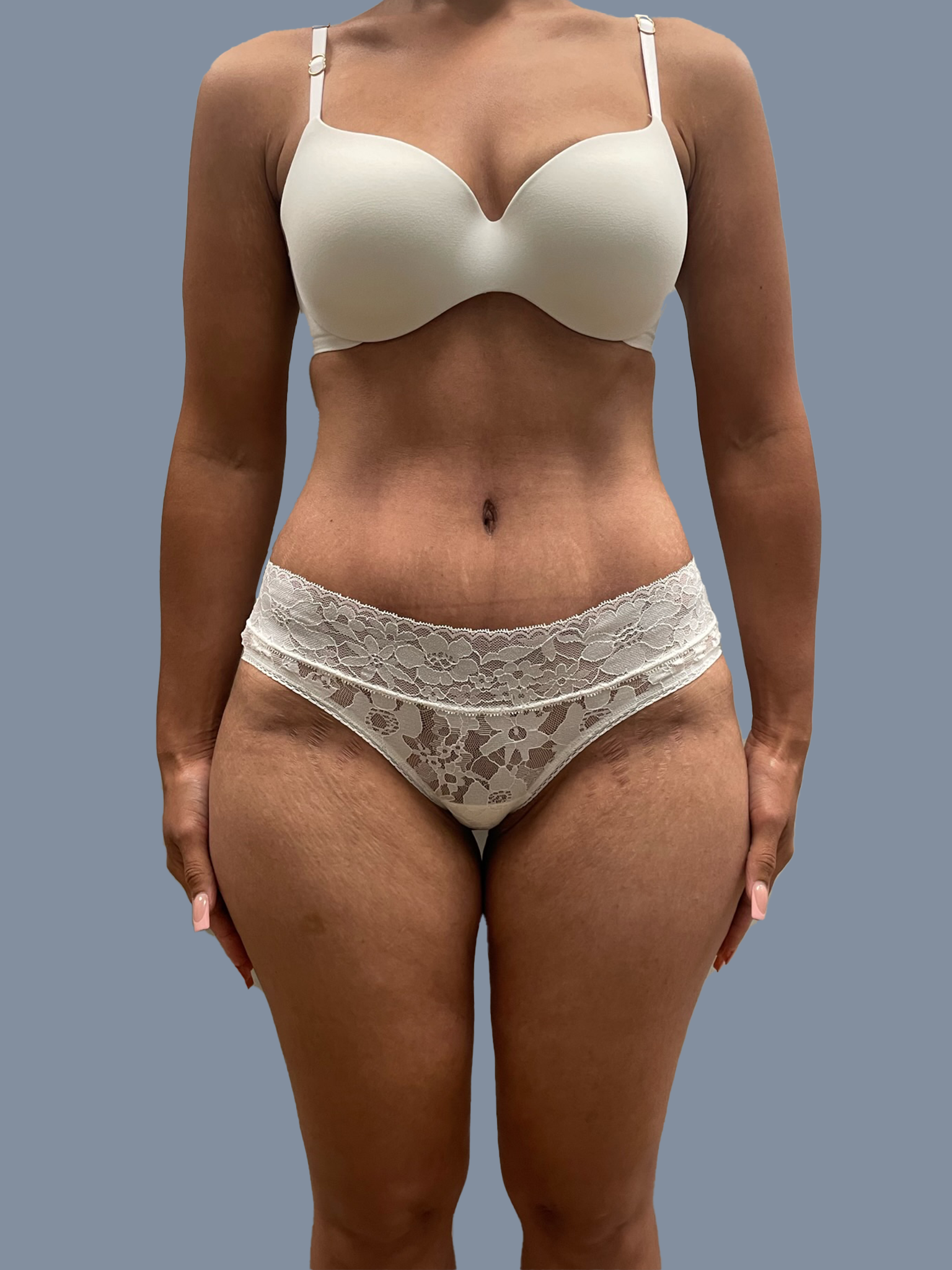 Liposuction 360 & Tummy Tuck