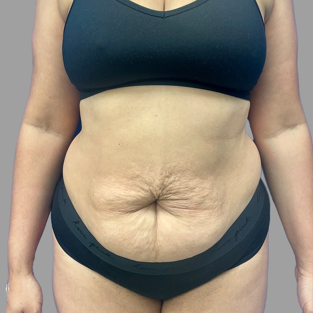 Case--8739 | Before Lipo 360 - Tummy Tuck