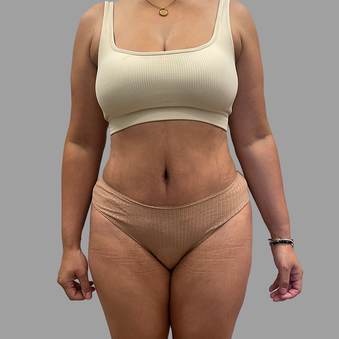Case--8739 | After Lipo 360 - Tummy Tuck