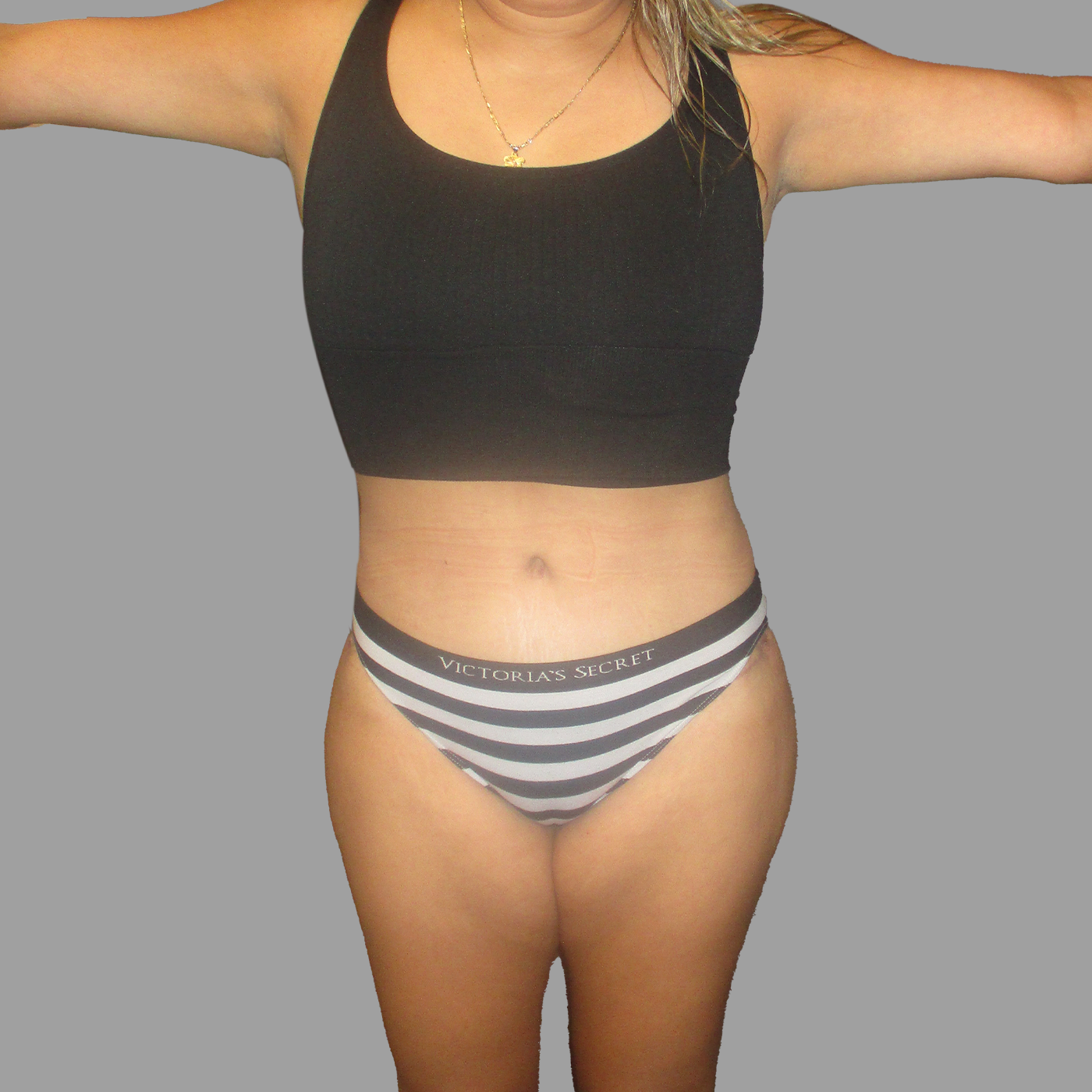 Liposuction 360 with Tummy Tuck
