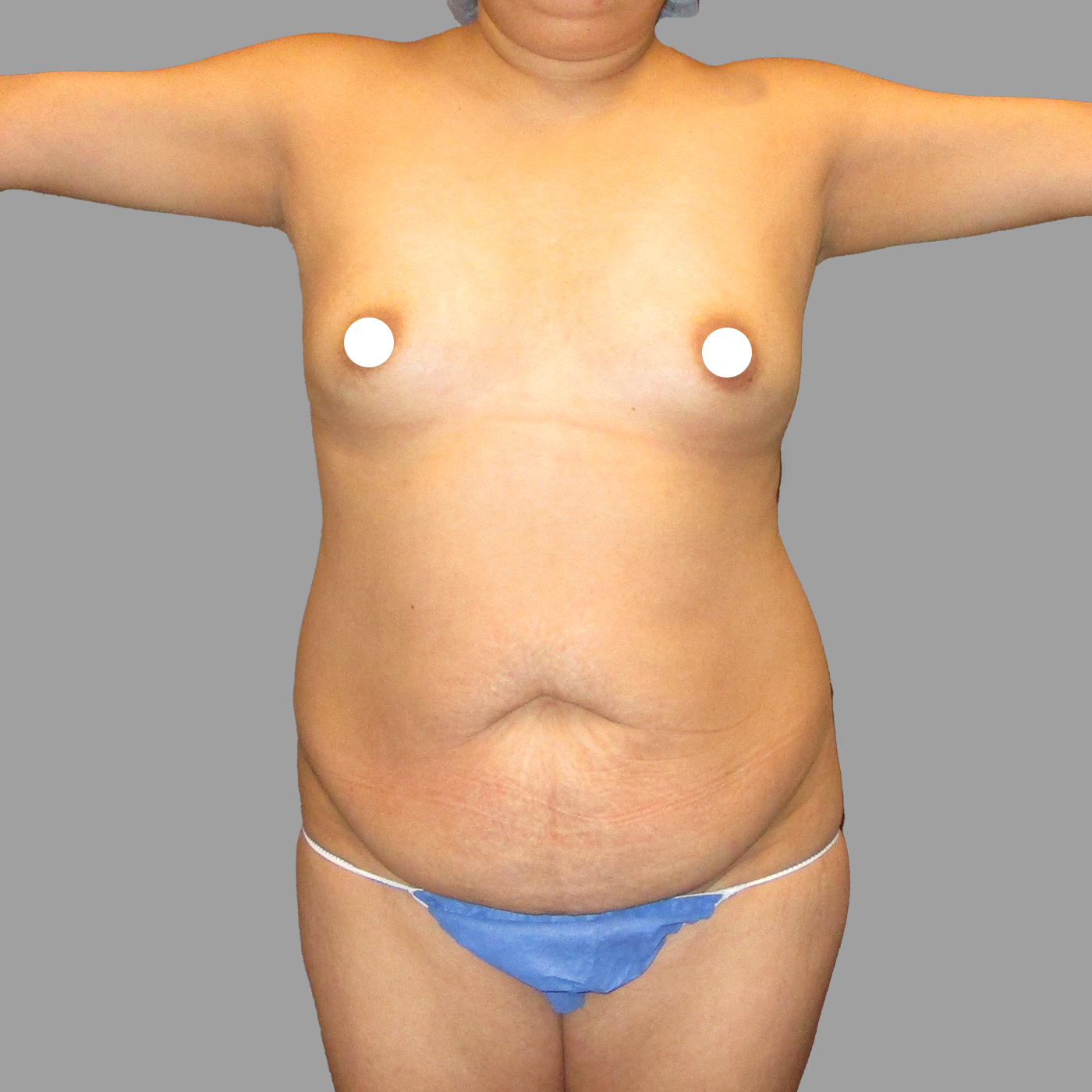 Liposuction 360 with Tummy Tuck